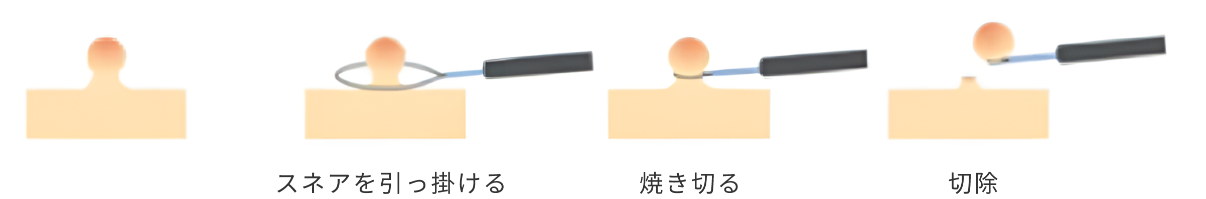 ポリペクトミー