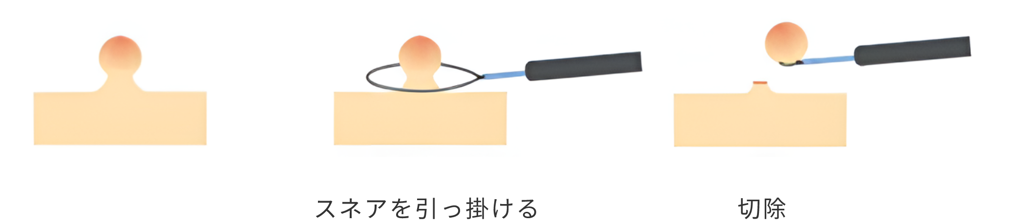 コールドポリペクトミー