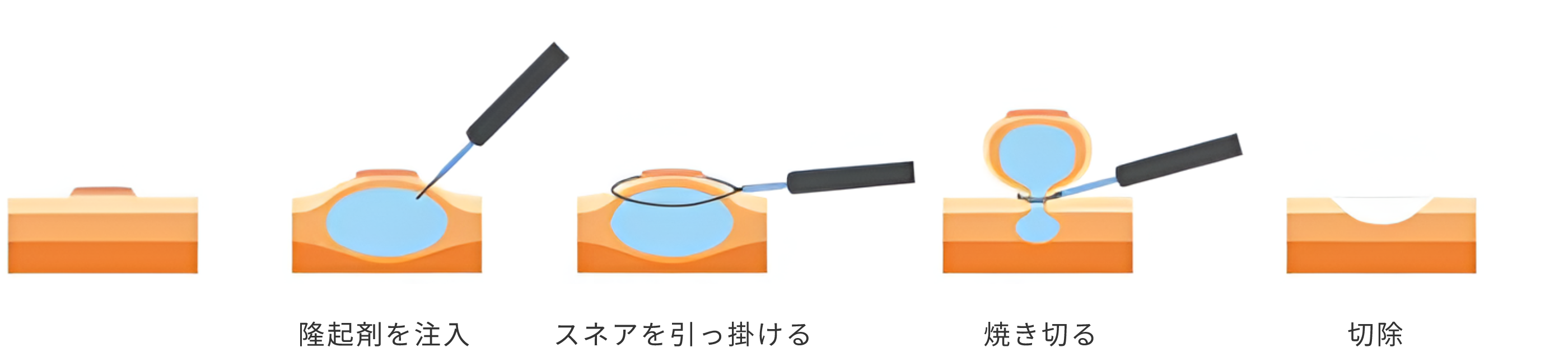 内視鏡的粘膜切除術（EMR）